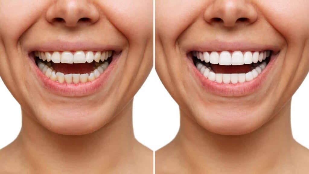 Before and after teeth whitening results. Norwich