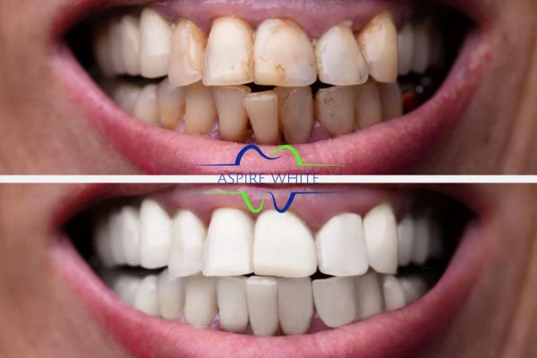 Before and after results of laser teeth whitening Norwich Book in online today!